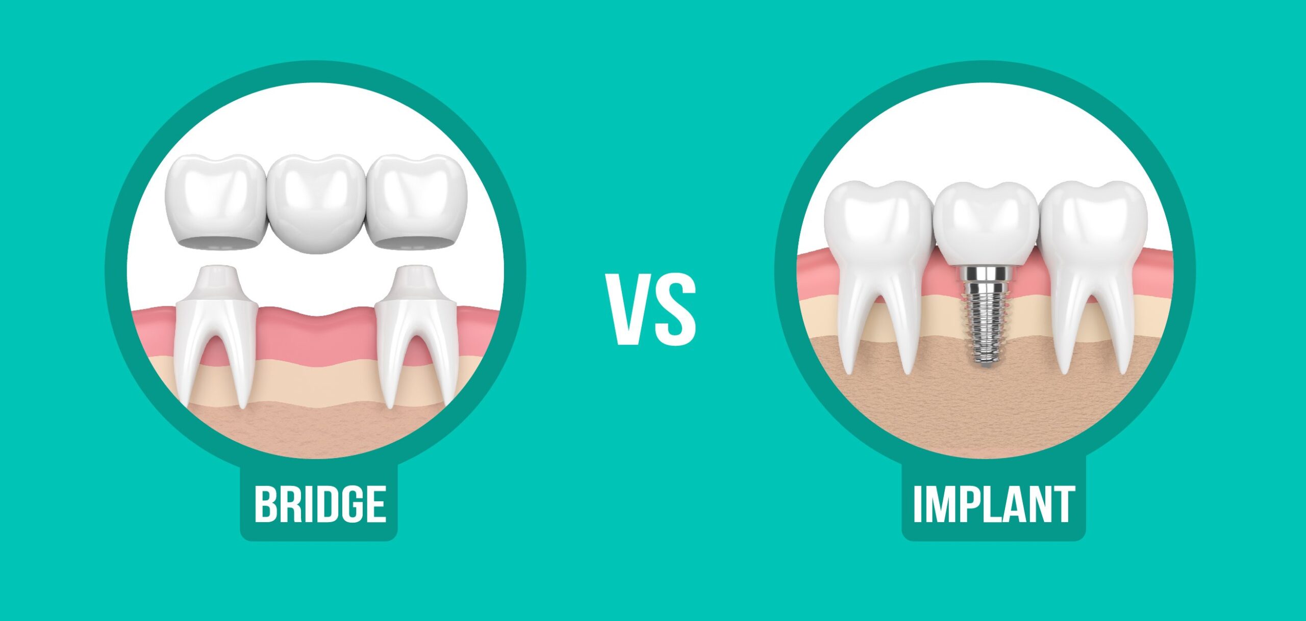 What’s Better: A Dental Implant or a Bridge?
